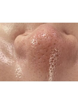 メンズフェイシャル