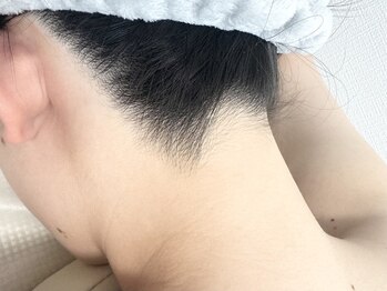 ナビ(nabi)の写真/この季節におすすめ◎ブライダルや様々な式に向けて♪人気の【WAX脱毛】うなじ（首の付け根まで）ご対応◎