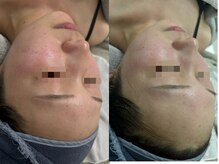 ファーファラ(Farfalla)/ハーブピーリング