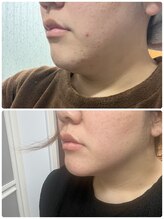 ヨサパーク リアン(YOSA PARK Lien)/モニター様before→after/痩身