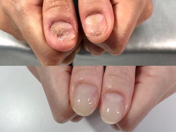 エスネイル(S-nail)/深爪矯正/自爪育成