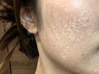 グリーンピール エルモナ(GREENPEEL ELMONA)/【グリーンピール5Days】シェド