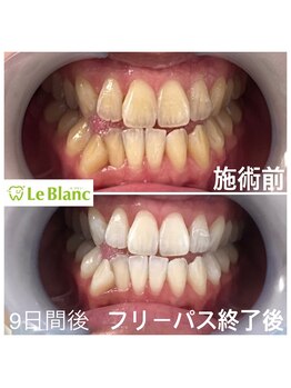 ルブラン 奈良店(Le Blanc)/９日間で白く！！