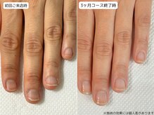 カピリナ(Ka Pilina)/自爪育成・川崎・深爪