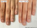 自爪育成・川崎・深爪