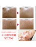 【最新のシミケア＊ヒト幹パック付】30分ケア放題¥23,100→¥7,700