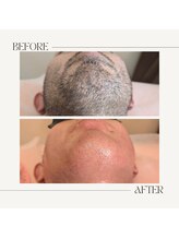 スプランドゥール(Splendeur)/メンズ【ひげ】WAX＋光