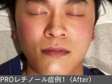 オアシスラグーン(OASIS LAGOON)/レチノール（症例1 after）