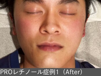 オアシスラグーン(OASIS LAGOON)/レチノール(症例1 after)