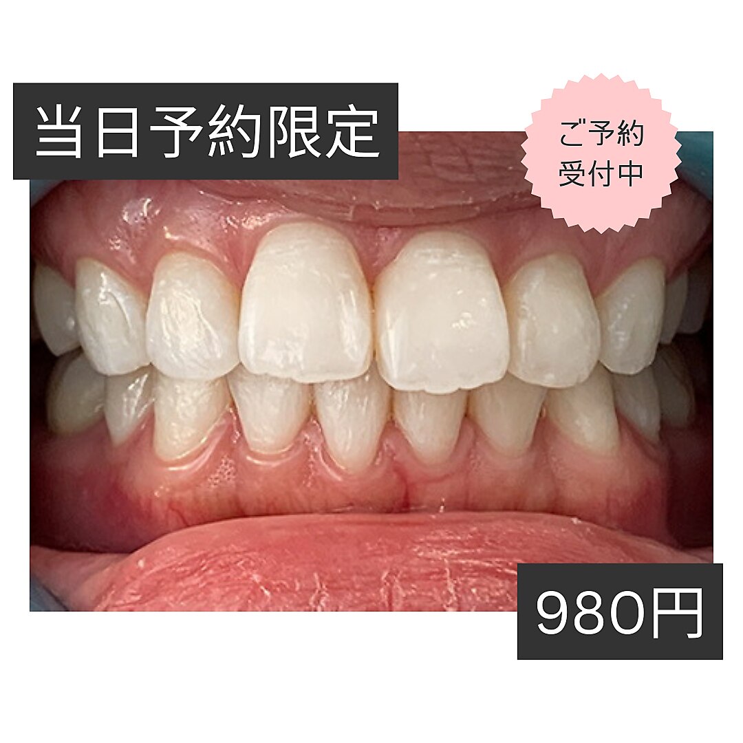 【当日予約限定＊まずはお試し】ホワイトニング 10分×2回 \6200→\980