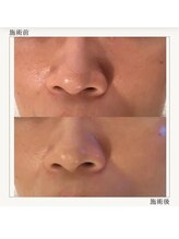 【毛穴レス肌へ】大人気★顔脱毛×剥離なしピーリング！黒ずみ・開きを徹底洗浄＆美白パック♪