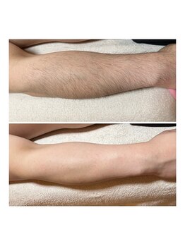 トゥルーカインド(true kind)/メンズひじ下脱毛