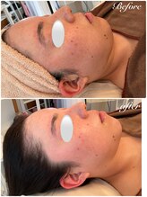 美バストアルファ(美bust α)/【小顔コルギ】