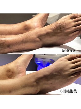 シャルム ド ケー(charme de k)/男性ひざ下脱毛