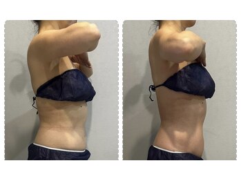 ラヴィエール(Laviere)/レディース痩身120分2回目