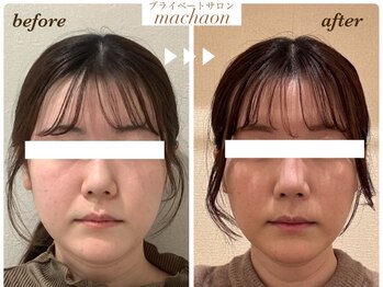 マカオン(machaon)/【小顔リフト】小顔マッサージ