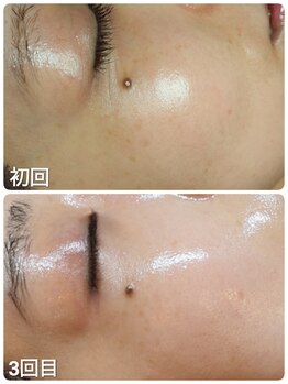 ウララ(ulala)/ララピール3回目