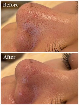 モテ 新宿店(Mote)/ハイドラ毛穴洗浄＋艶肌Wax 新宿