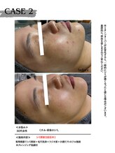 ミウル 天王寺店(miulu)/30代女性/シミ照射3回