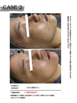 ミウル 天王寺店(miulu)/30代女性/シミ照射3回