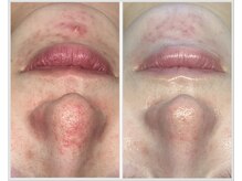 美しぐれ 溝の口店/【1ヶ月】LDM/LED/酸素ドーム