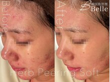 【毛穴｜ハーブピーリング】韓国肌管理Belle 新橋/ハーブピーリング｜ニキビケア