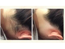 ルルトウキョウ 池袋店(LULU.tokyo)/うなじ脱毛/1回目→8回目