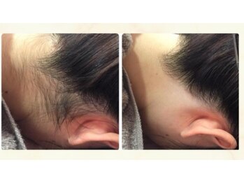 ルルトウキョウ 池袋店(LULU.tokyo)/うなじ脱毛/1回目→8回目