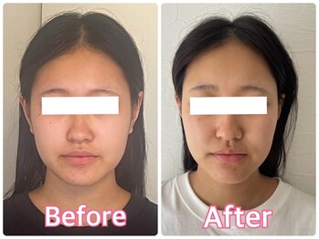 小顔矯正サロン ブルーム/Vラインのフェイスライン