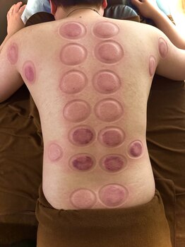 クレオーラ(Creola)/カッピング　跡