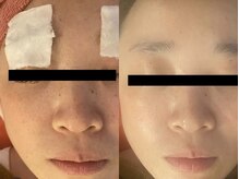 スターリィ スカイ(Starry☆Sky)/美白トリートメント