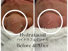 トウキョウビューティーラボ(TOKYO BEAUTY LABO.)/ハイドラBefore&After