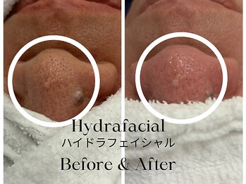 トウキョウビューティーラボ(TOKYO BEAUTY LABO.)/ハイドラBefore&After