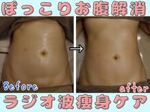 プレフィール(PLEAFEEL)/むくむく寸胴腹症例