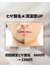 【メンズ脱毛】清潔感UP!ヒゲ脱毛+ハイドロジェリーマスク付き 3,300円