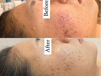 クレールアンジュ(ClairAnge)/赤ら肌、凸凹ケア、肌荒れケア