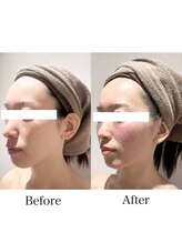 銀座レイア/フェイシャルビフォーアフター