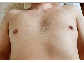 ディスイズミー(This is ME)/男性 お胸 1回