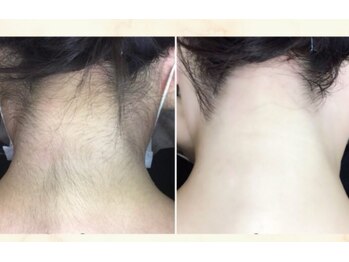 ルルトウキョウ 池袋店(LULU.tokyo)/うなじ脱毛/1回目→8回目