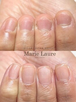 マリーロール 天王寺店(Marie Laure)/深爪矯正/自爪育成/ネイルケア/
