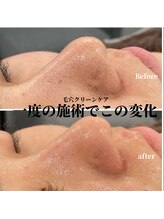 サロン ド リリー(salon de lily)/毛穴クリーンケア