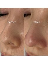 ワンダーウォール 福岡城南店(WONDER WALL)/毛穴洗浄