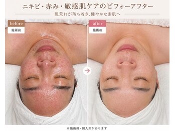 ジョジョイー(JoJoYEE)の写真/毛穴・肌荒れ・くすみ改善へ♪肌質から整えて透明感あふれる美肌へ