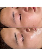 プリュムアイ フェイシャルホーム(prume eye.facial home)/ハーブピーリング