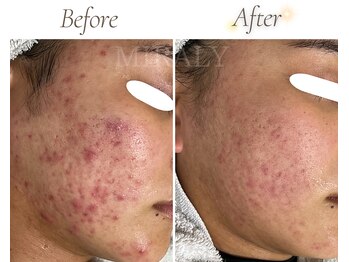 ミラリー(MIRALY)/肌荒れ跡ニキビケア 6ヶ月(20代)