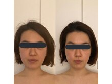 ハイコガオ(HIKOGAO)/小顔矯正40分