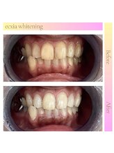 エクシアホワイト 新宿御苑店(ecxia white)/ホワイトニングビフォーアフター