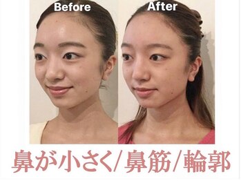 ラプリボーテ(Raplit BEAUTE)/隆鼻＋輪郭矯正40分10回