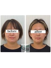 キュープ 浜松店(Qpu)/ほうれい線、たるみが改善♪