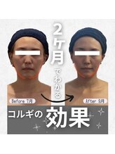 小顔フェイスラボ 難波店(小顔 Face Labo)/【2カ月で小顔】